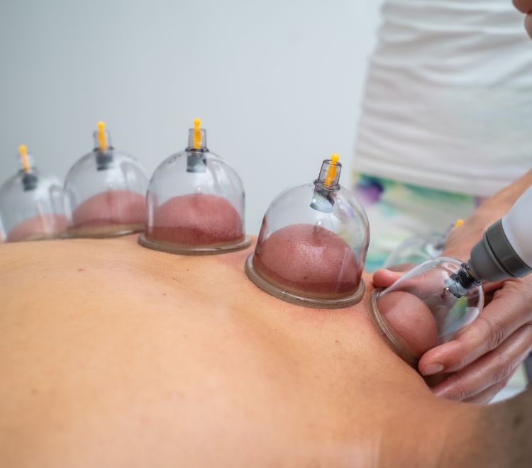 Cupping